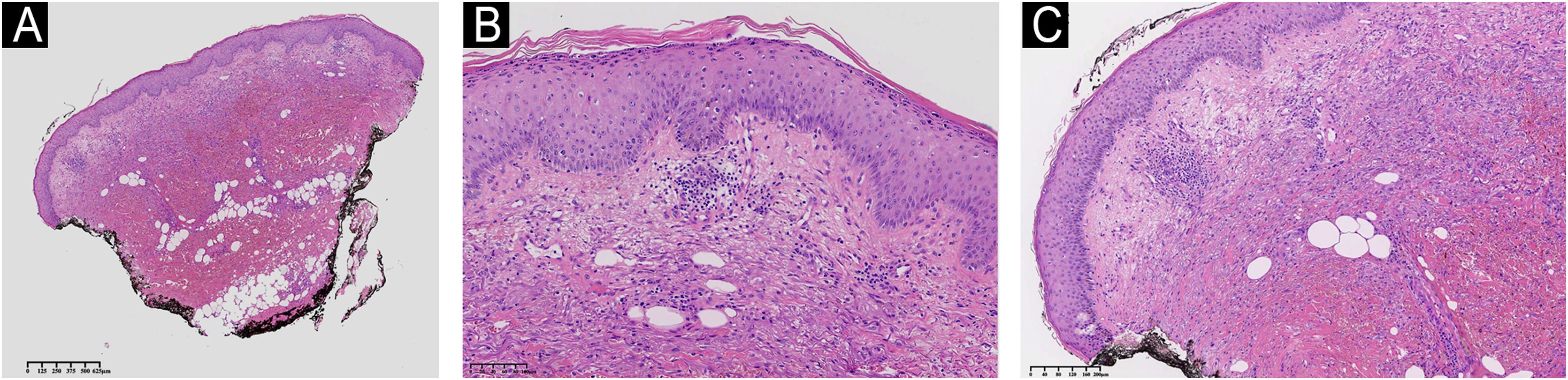 Pyoderma Gangrena Pyoderma gangrenosum diagnosed in a high-risk myelodysplastic neoplasm ...