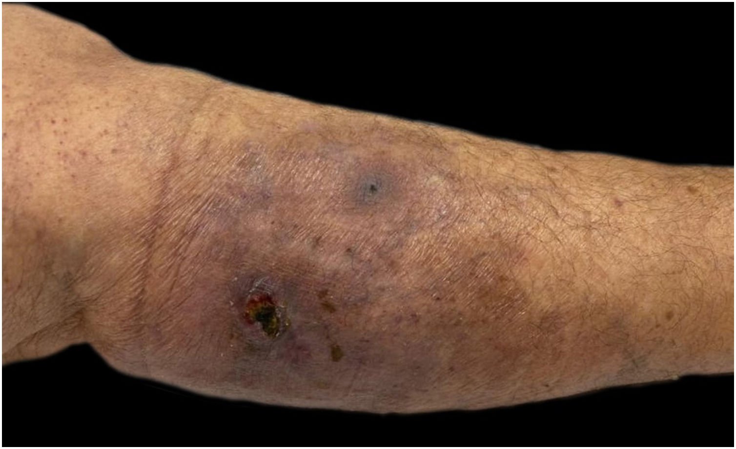 Pyoderma gangrenosum diagnosed in a high-risk myelodysplastic neoplasm ...
