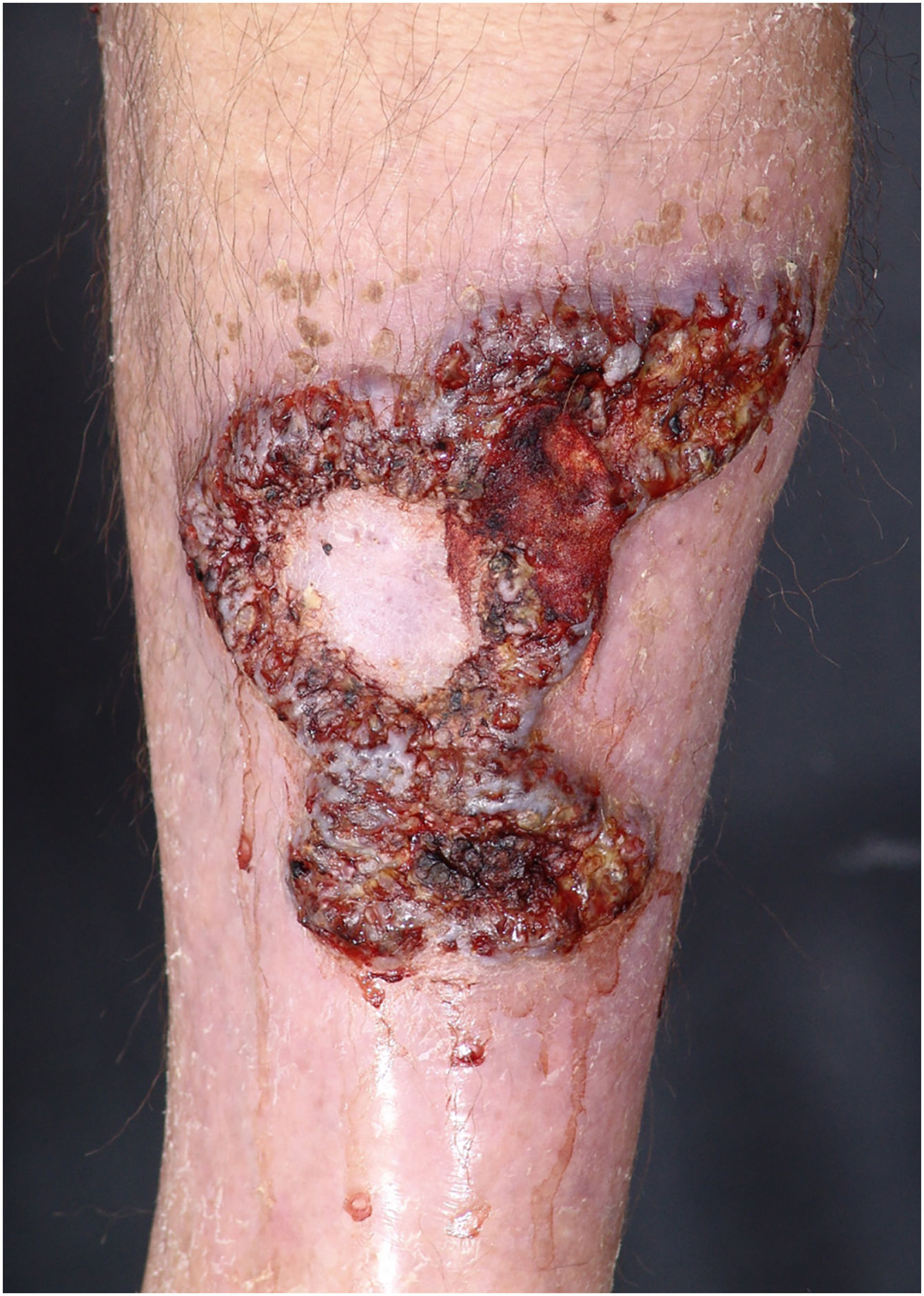 Pyoderma gangrenosum: a 22-year follow-up of patients in a tertiary ...