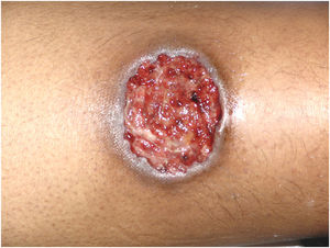 Clinical subtype of pyoderma gangrenosum – ulcerative.