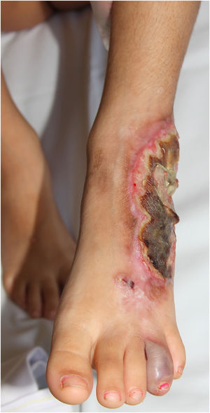 Clinical subtype of pyoderma gangrenosum – bullous.