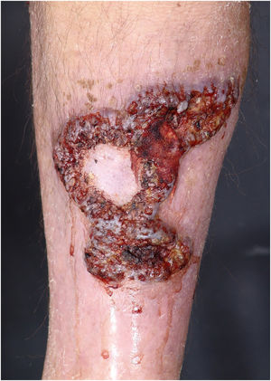 Clinical subtype of pyoderma gangrenosum – vegetative.