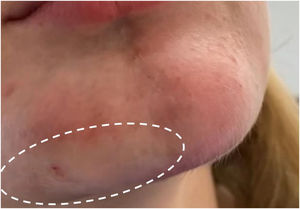 Blanching of the right lateral chin region (dotted area) during hyaluronic acid injection, indicating likely ischemia in the area.