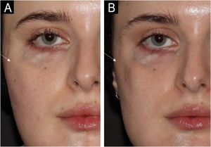 The same patient with an 80-day interval. On the day of the first photo (A), 0.9 mL of Restylane Defyne was injected into the right zygomatic region (result not shown). Despite this, in photo B, 80 days after the injection, the zygomatic region (white arrow) appears visibly more depressed than in the previous photo. This absorption pattern was observed over the three years of follow-up, which may represent accelerated hyaluronic acid absorption.