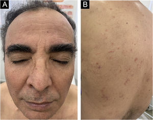 Significant improvement of skin lesions after 2 doses of Guselkumab.