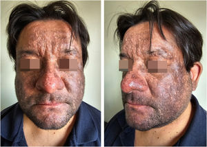 Brown-gray patches with purplish hue on the face. Note eyelids involvement.