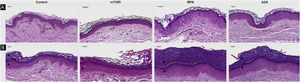 Histopathological differences related to the epidermal analysis of photoprotected (A) and photoexposed (B) skin of the control groups and renal transplant recipients submitted to immunosuppression regimens with mTOR inhibitors (mTORi), Mycophenolic Acid (MPA) and Azathioprine (AZA). The control group exhibits a basket weave pattern in the stratum corneum, typical of healthy non-acral photoprotected skin (arrow) and well-demarcated epithelial cones (discontinuous arrow). The mTORi group reveals a lamellar pattern in the stratum corneum, reduced number of epidermal cell layers, and rectification of the epithelial cones, both in photoprotected skin (discontinuous arrow; A) and in photoexposed skin (B). As a rule, photoexposed skin samples (B) exhibit thicker epidermis with hyperkeratosis and increased number of cell layers in the epithelial cones and in the epidermal segments between the cones, aspects which are more pronounced in the MPA (arrowheads) and AZA groups. (Hematoxylin & eosin, ×40; scale bar 50 m).