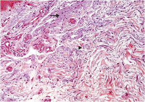 Histopathological characterization of dermal findings in photoexposed skin of a renal transplant recipient of the mTORi group. Solar elastosis is characterized by amorphous (arrow) and fibrillar (arrowhead) basophilic areas in the dermal connective tissue, where elastic fibers lose their usual characteristics. (Hematoxylin & eosin, ×200). mTORi, mTOR Inhibitors Group.