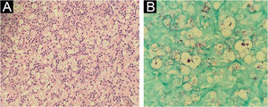 Inguinal lymph node histopathology – (A) Presence of a diffuse histiocytic infiltrate, lymph node stroma disorganization and presence of typical lymphocytes (Hematoxylin & eosin, ×40); (B) Presence of numerous acid-fast bacilli, organized in clusters within xanthomatous histiocytes (Fite-Faraco, ×100).