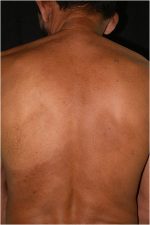 Hypochromic spot affecting the scapular and infrascapular region, extending to the left costal region, anesthetic on esthesiometry examination. On the periphery of the lesion, a discreet, poorly delimited erythematous-brownish area is observed.