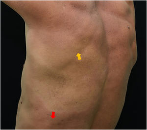 Hypochromic spot affecting the scapular and infrascapular region, extending to the anesthetic left costal region. The yellow arrow points to the biopsied area of suspected leprosy. The red arrow points to an area of discrete peripheral infiltration, which was also biopsied.