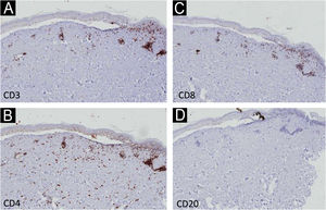 Immunohistochemistry – low magnification (×40) showing light dermal infiltrate with positivity for CD3, CD4 and CD8 cells (A‒C), and negativity for CD20 (D).