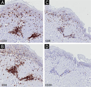 Immunohistochemistry – detail (×400) showing stronger positivity in the dermis for CD3 and CD4 (A and B) and in the epidermis for CD3 (A) and CD8 (C). Negativity for CD20 (D).
