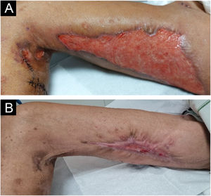 Pyoderma gangrenosum-like sporotrichosis. (A) Ulcer in the medial region of the right thigh with satellite lesions along the lymphatic tract. (B) Significant clinical improvement of the lesion after three months of treatment with potassium iodide.