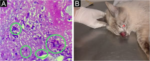 (A) Oval and elongated yeast-like structures in the deep dermis. (PAS, ×400). (B) Patient
