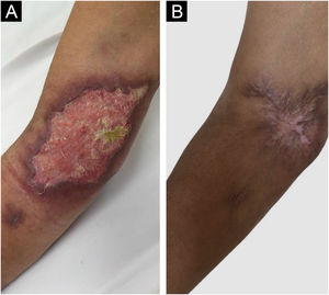Pyoderma gangrenosum-like sporotrichosis. (A) Ulcer in the right antecubital fossa with satellite lesion. (B) Healing of the lesion after two months of treatment with potassium iodide.
