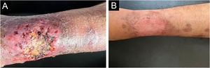 Pyoderma gangrenosum-like sporotrichosis. (A) Ulcer on the left leg with satellite lesions. (B) Healing of the lesion after four months of treatment with itraconazole and potassium iodide.