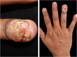 Clinical manifestation of IgG4-related disease in the nail: (A) significant involvement of the nail apparatus with edema in the proximal nail fold, nail bed ulceration, and complete absence of the nail plate. (B) Onychodystrophy is seen in the other nail plates.