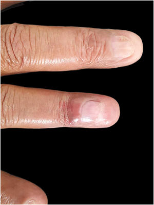 Result of treatment of IgG4-related nail disease: significant improvement with functional maintenance of the finger.