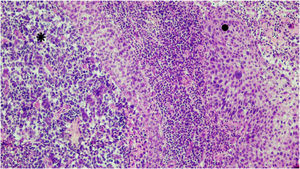 Squamous cell carcinoma (●) coexisting with Merkel cell carcinoma (⁕). Hematoxylin & eosin, ×100.