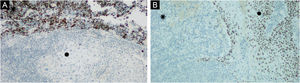(A) CK20 positive “dot” pattern in Merkel cell carcinoma (⁕) and negative in squamous cell carcinoma (●). CK20 (SP33), ×100. (B) P63 negative in Merkel Cell Carcinoma (⁕) and positive in squamous cell carcinoma (●). P63 (4A4), ×100.