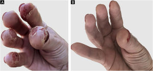 Case 1 (A) shows extensive erythematous and desquamative lesions, especially on the digital pulps of the right hand, with some crusts; (B) complete improvement of the skin lesions after upadacitinib.
