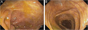 Ileocolonoscopy after treatment with upadacitinib. The ileocecal valve (A) and the cecum (B) show complete mucosal healing.