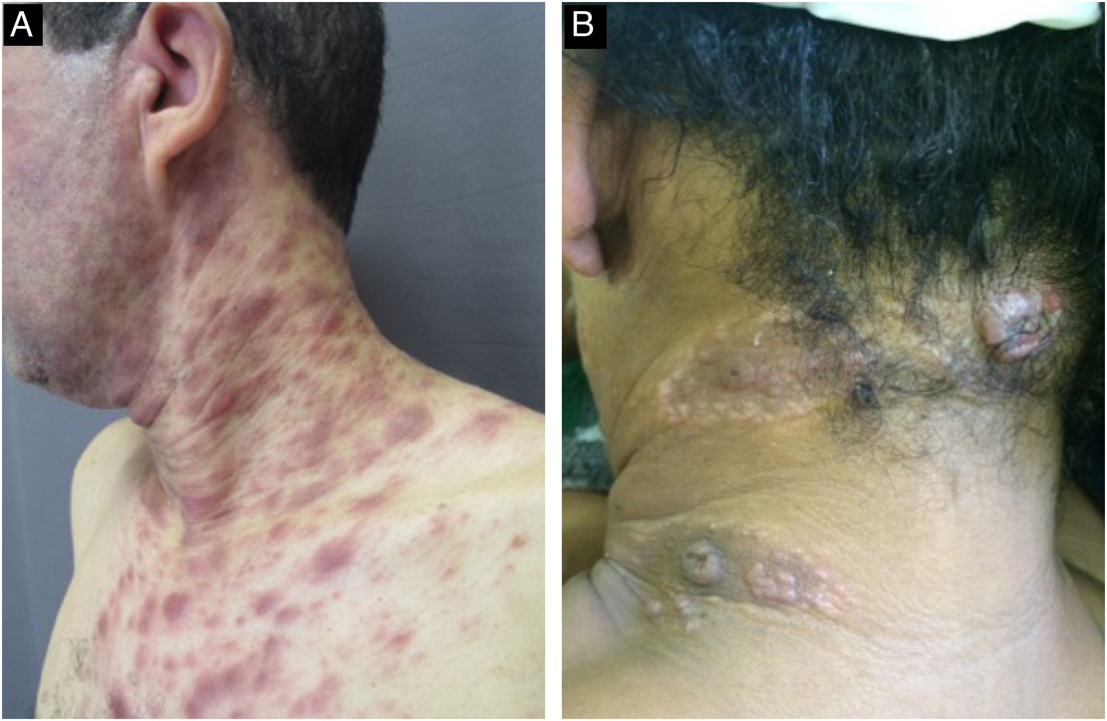 Acquired syphilis: update on clinical, diagnostic and therapeutic ...