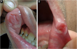 Oral mucosal lesions of secondary syphilis. A- linear erosions on the labial mucosa (“snail track ulcers”); B Papules with transverse erosions on the labial commissure (“split papules”).