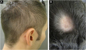 Manifestations of alopecia in secondary syphilis. A - Diffuse essential alopecia; B- Alopecia areata-like lesion.
