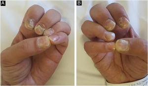 A and B- Involvement of the nail apparatus in a patient with secondary syphilis, characterized by onychomadesis.