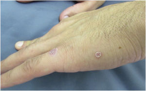 Detail of a lesion in a patient with secondary syphilis, showing Biet