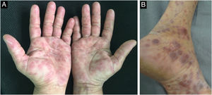 Palmoplantar involvement of secondary syphilis. A- Erythematous papules and macules on the palmar region; B- Erythematous-violaceous papular lesions on the plantar region.