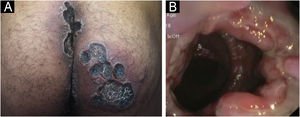 (A) Ulcero-necrotic lesions on the buttocks. (B) Colonoscopy image: ulcerative proctitis.