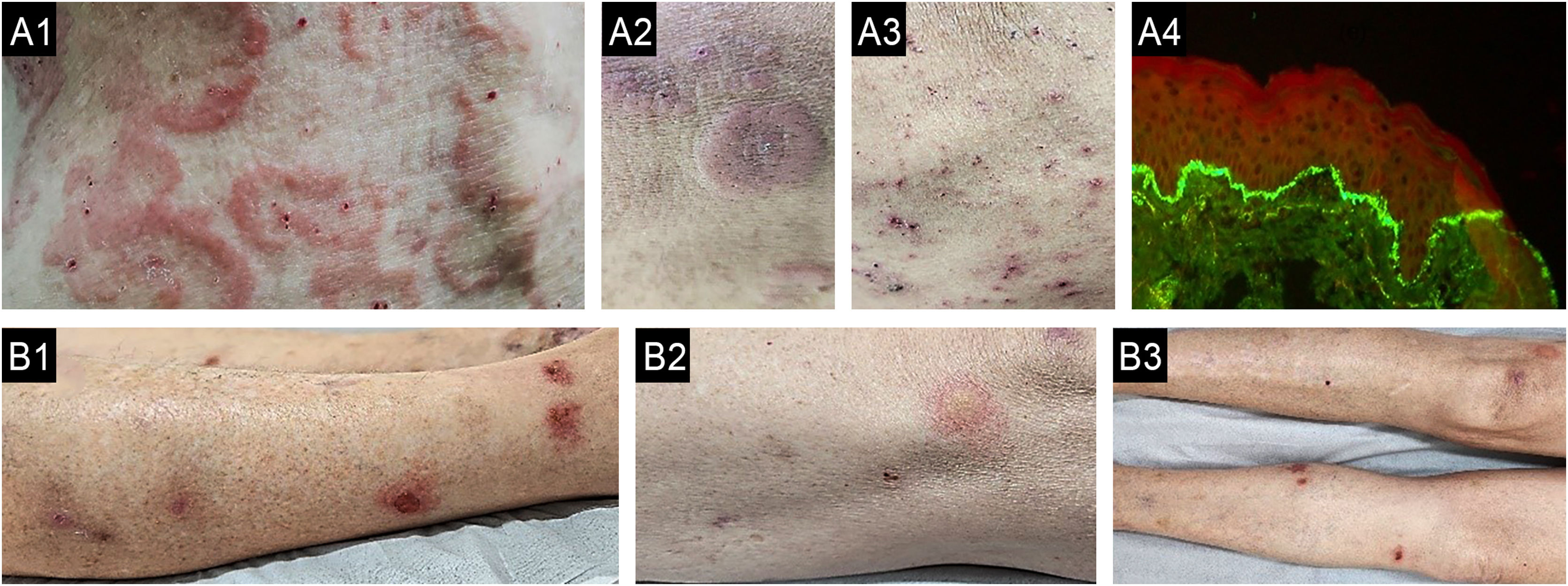 Hyperchromic Rash Chronic pruritus: a narrative review | Anais Brasileiros de Dermatologia