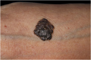Clinical features of a well-demarcated, partially keratinized, elastic hard black nodule on the forearm.