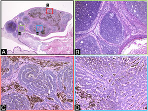 Histopathological features. (A) Protruding lesion with well-defined large and small tumor nests within the dermis. (B) Region of nodular BCC. (C‒D) Tumor cells exhibit a complex cord-like arrangement, forming a pattern described as labyrinthine. (Hematoxylin & eosin; A:×20, B:×200, C:×200, D:×200).