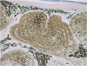 Immunohistochemical features showing diffuse immunoexpression of BerEP4. (×200).
