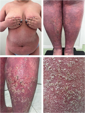Patient in flare before the infusion ‒ GPPASI = 54.2 and GPPGA = 4.