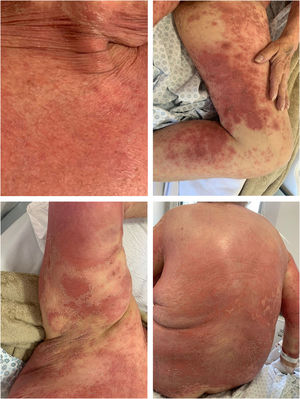 Patient during hospitalization in flare – GPPASI = 23.1 and GPPGA = 3.