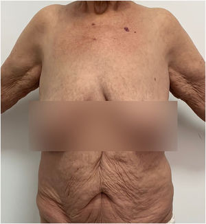 One week after 2 doses of spesolimab administered at weekly intervals.