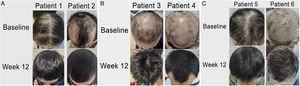 (A‒C) Representative figures of AA patients at baseline and 12-weeks after treatment.