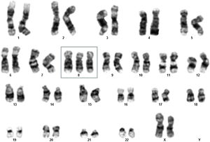 Karyotype analysis of elderly female myelodysplastic neoplasm/syndrome patient demonstrating 47,XX,+8[11]/46,XX[1].