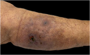 Pyoderma gangrenosum lesion regression after dapsone treatment.