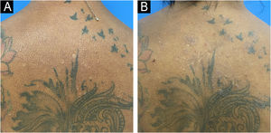 Infiltration improvement and papule reduction on the upper back (A) before treatment and (B) after treatment.