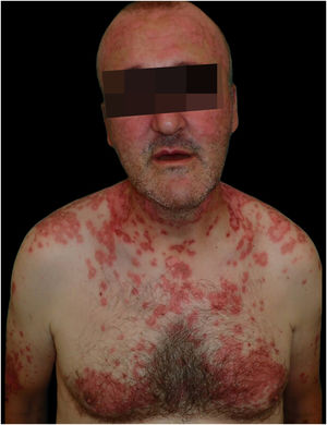 Erythematous targetoid coalescent rash with cephalocaudal distribution and central erosion involving the face, neck, upper trunk, and back.