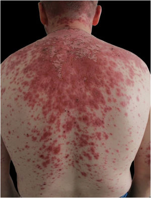 Erythematous coalescent rash with central erosion in upper trunk.