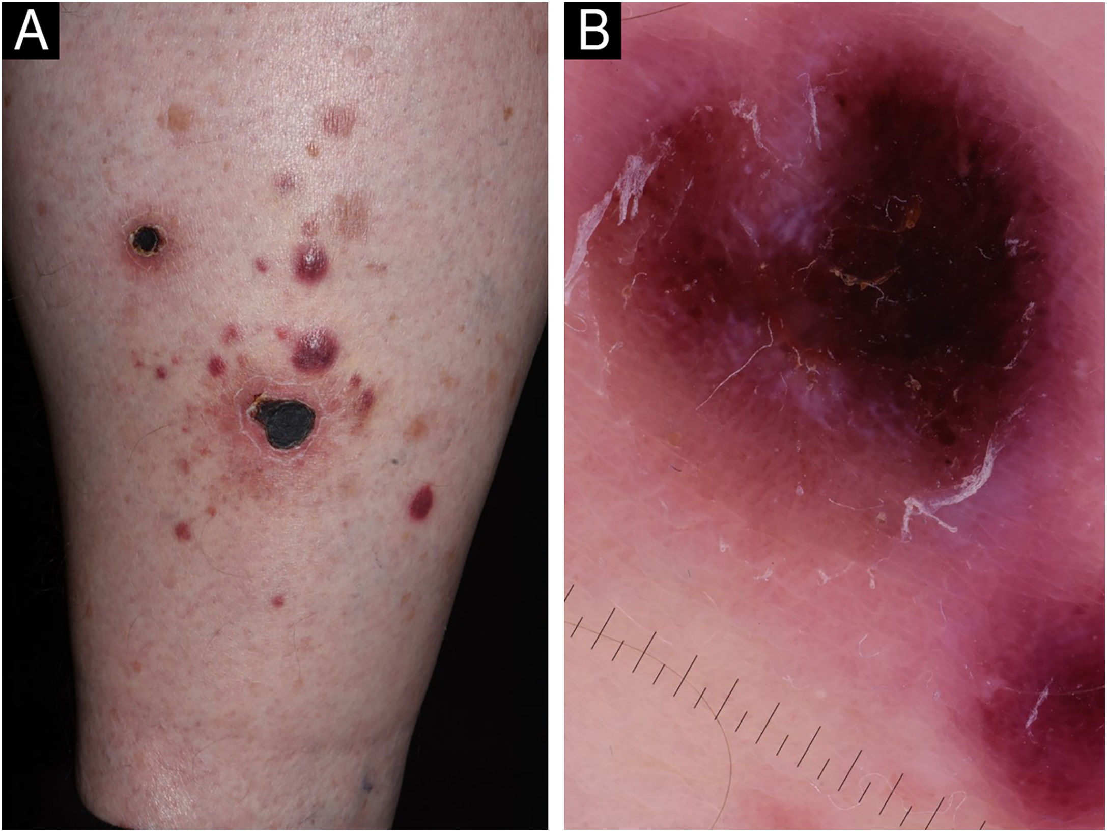 Lyp Rare case of lymphomatoid papulosis type E | Anais Brasileiros de ...