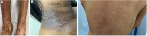 (A‒C) Characteristic features of atopic dermatitis in Brazilian patients.
