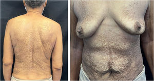 Clinical presentation of terra firma-forme dermatosis (TFFD).